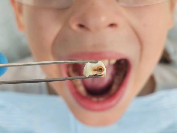 Best Emergency Treatment for Toothache in South Highpoint, FL